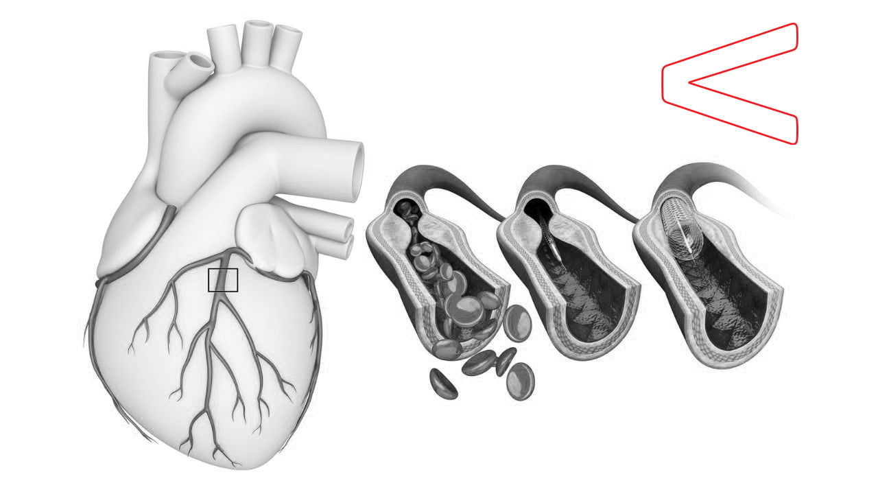 Coronary Artery Bypass Surgery.jpg