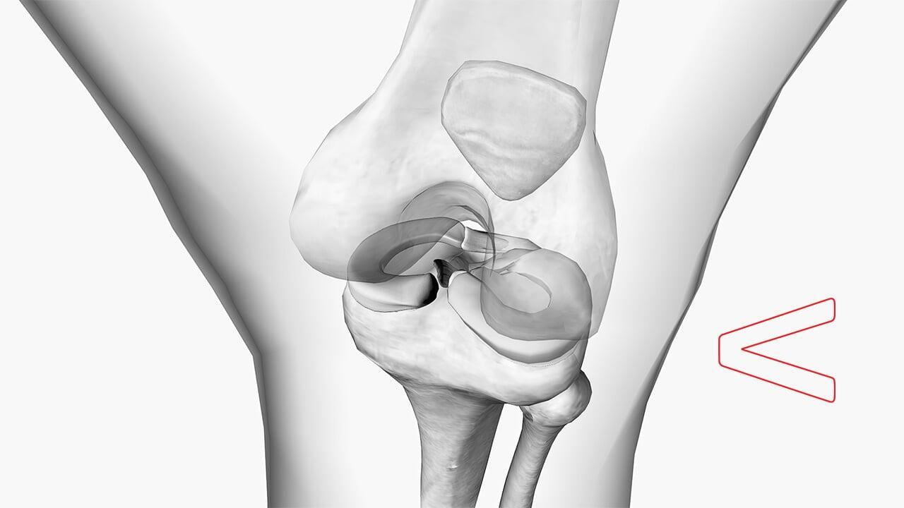 Medial Meniscus Tear.jpg
