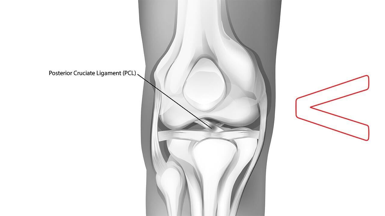 PCL Surgery - Ortho.jpg