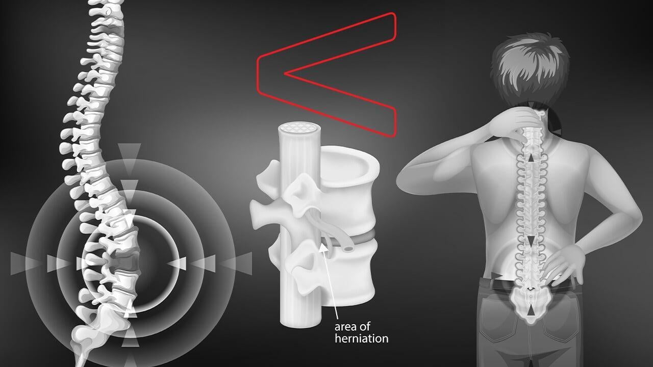 Slip Disc and Herniated Disc.jpg
