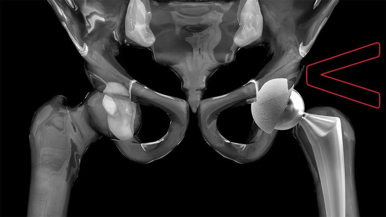 Total Hip Replacement.jpg
